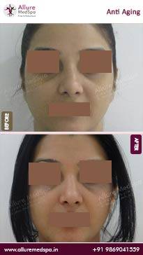 Anti-Aging-Before-and-After-Images-in-Mumbai-India