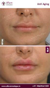 Anti-Aging-Before-and-After-Pictures-in-Mumbai-India