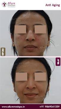 Anti-Aging-Treatment-Before-and-After-Gallery-in-Mumbai-India