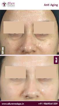 Anti-Aging-Treatment-Before-and-After-Images-in-Mumbai-India