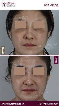 Anti-Aging-Treatment-Before-and-After-Photos-in-Mumbai-India