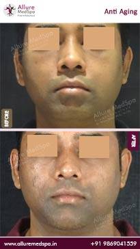 Anti-Aging-Treatment-Before-and-After-Pictures-in-Mumbai-India