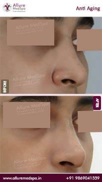 Anti-Aging-Treatment-Before-and-After-Result-in-Mumbai-India