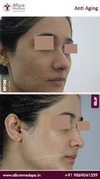 Anti-Aging-Treatments-Before-and-After-Result-in-Mumbai-India