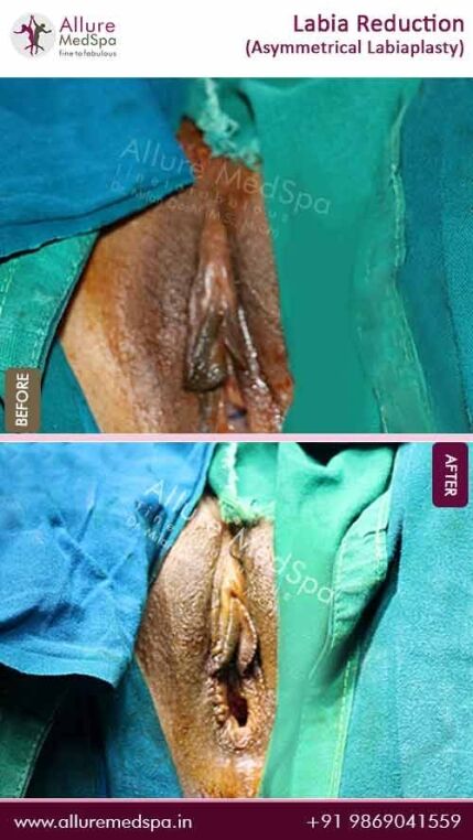 Labia-Reduction-Before-After-Image-Mumbai-India