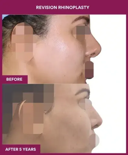 Revision Rhinoplasty Before After Image in Mumbai