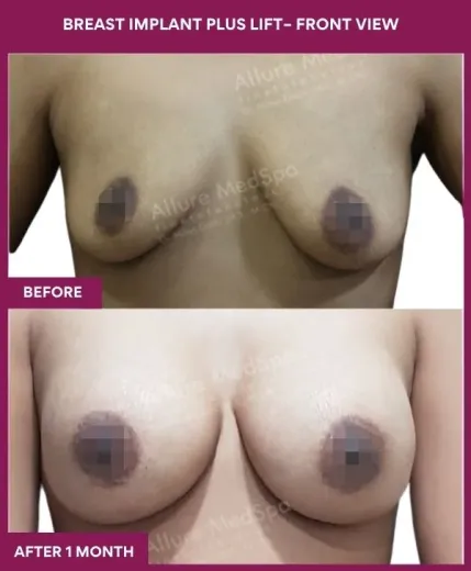 1 BREAST IMPLANT PLUS LIFT– Front View_1