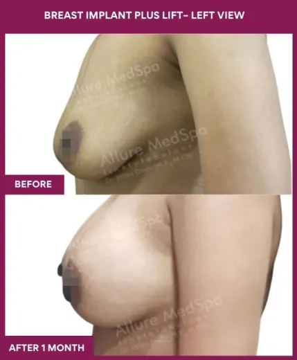 1 BREAST IMPLANT PLUS LIFT– Left View_2