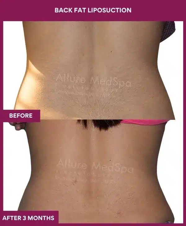 1 Back Fat Liposuction_35