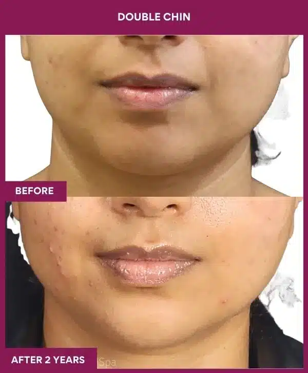 1 Double Chin (3)_49