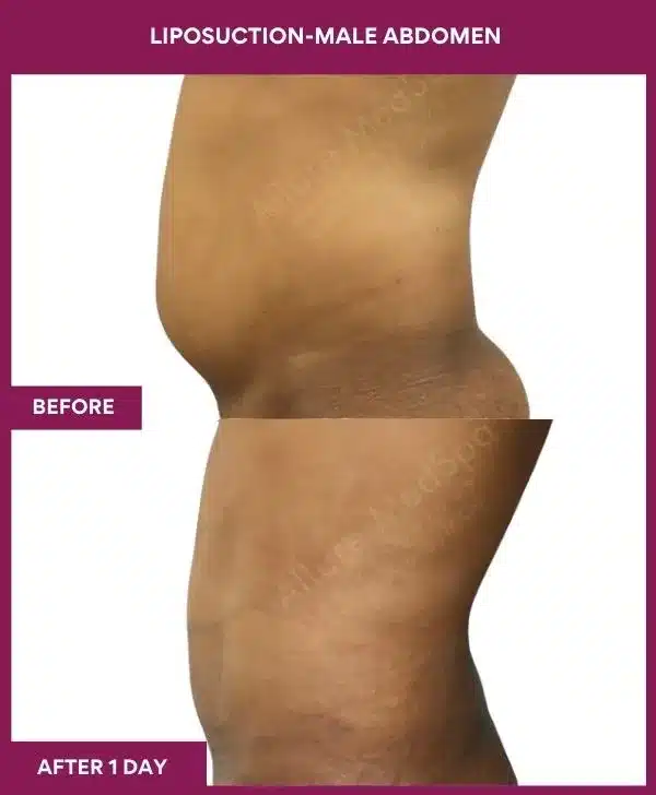 1 LIPOSUCTION-MALE ABDOMEN (3)