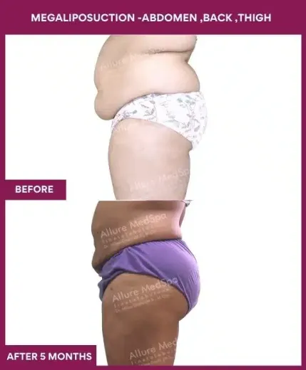1- MEGALIPOSUCTION -ABDOMEN ,BACK ,THIGH-1