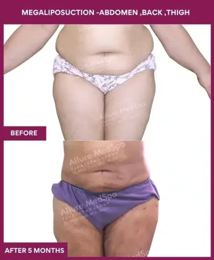 1-MEGALIPOSUCTION -ABDOMEN ,BACK ,THIGH