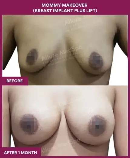 1 Mommy Makeover (BREAST LIFT)_37 (1)