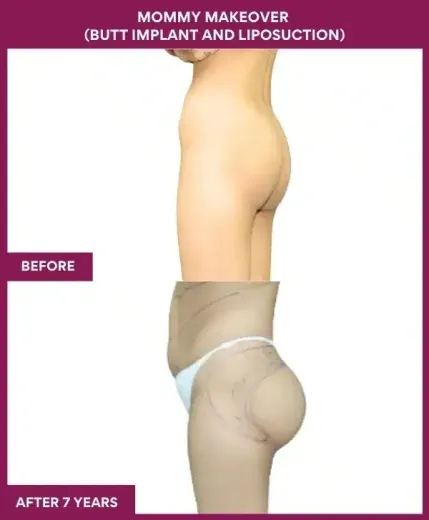 1 Mommy Makeover (BUTT IMPLANT AND LIPOSUCTION)_61 (3)