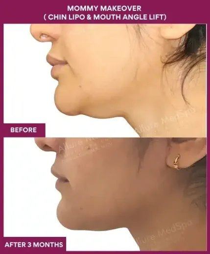 1 Mommy Makeover ( Chin Lipo & Mouth Angle Lift) (3)_79