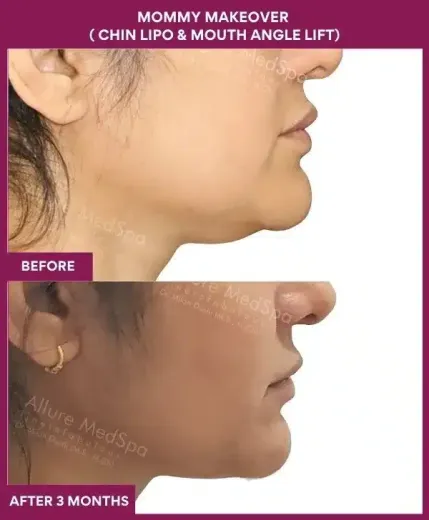 1 Mommy Makeover ( Chin Lipo & Mouth Angle Lift) (5)_79