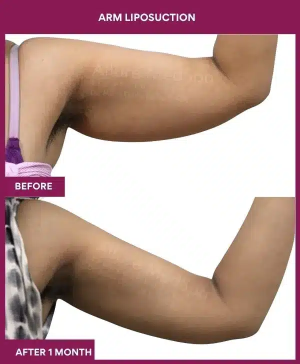 1-arm LIPOSUCTION-- (2)