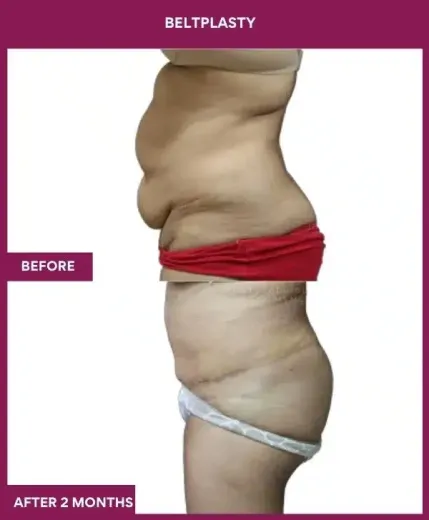 10 BELTPLASTY_21_ (6)