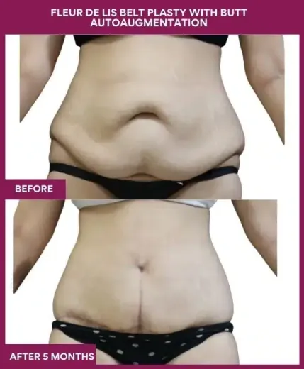 11 Fleur de lis Belt plasty with butt autoaugmentation_ (4)