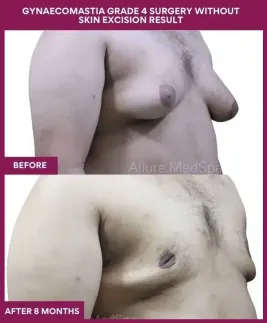 11- GYNAECOMASTIA GRADE 4 SURGERY WITHOUT SKIN EXCISION RESULT_