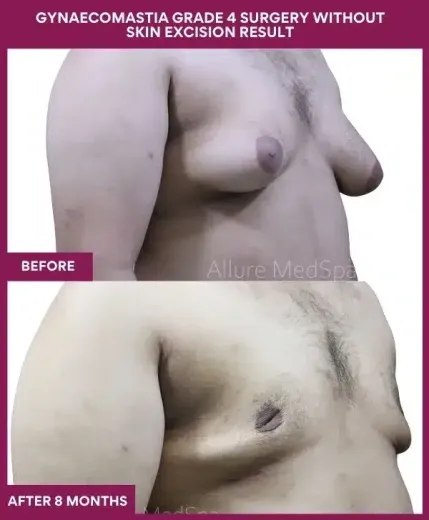 11- GYNAECOMASTIA GRADE 4 SURGERY WITHOUT SKIN EXCISION RESULT_
