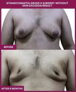 11- GYNAECOMASTIA GRADE 4 SURGERY WITHOUT SKIN EXCISION RESULT_