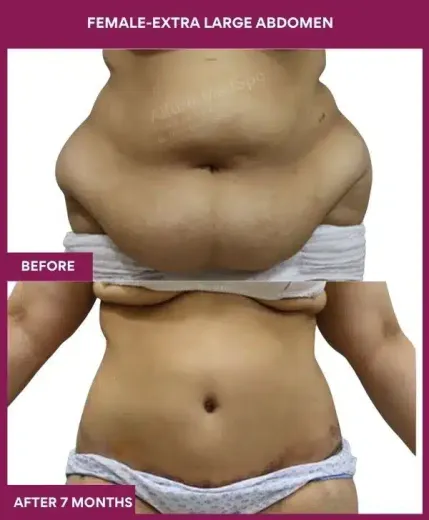 13 FEMALE-EXTRA LARGE ABDOMEN_ (1)