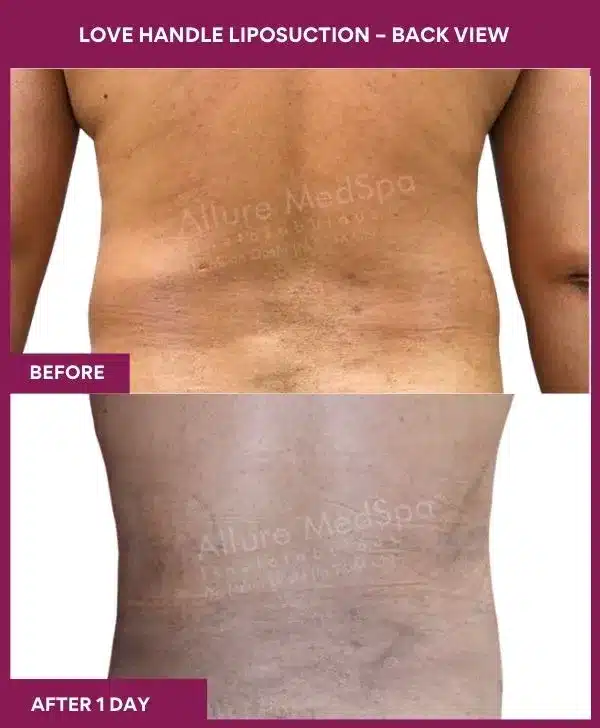 13- Love Handle Liposuction – Front View-