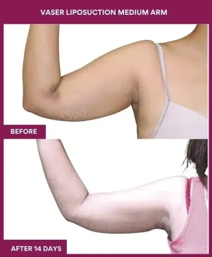 16 VASER LIPOSUCTION MEDIUM ARM