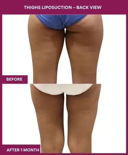 18 Thighs Liposuction – Back View