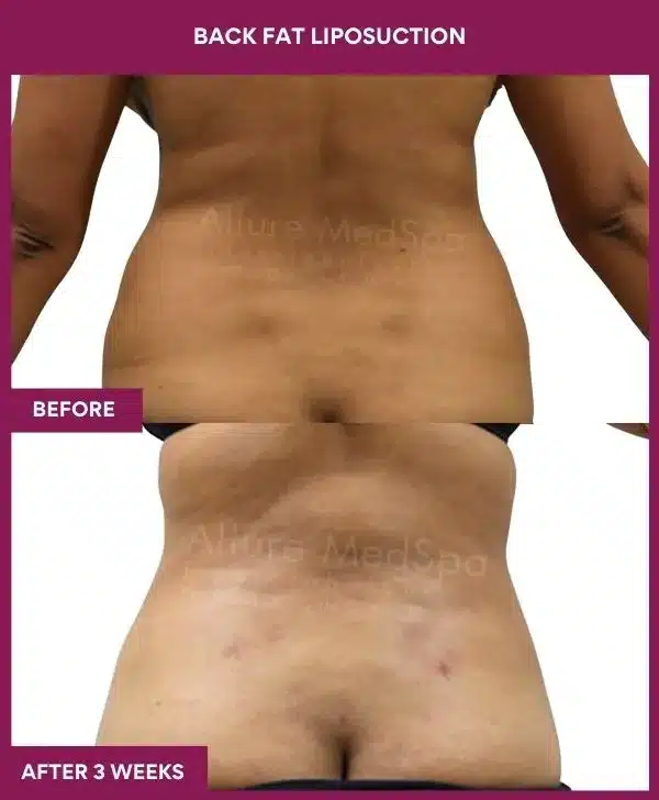 2 Back Fat Liposuction_36