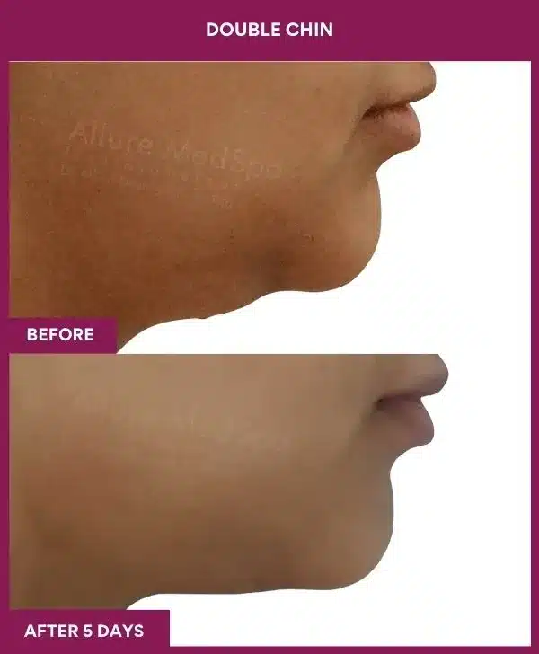 2 Double Chin (2)_52