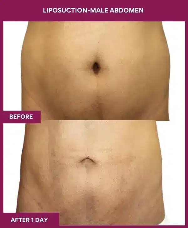 2 LIPOSUCTION-MALE ABDOMEN_6_ (1)