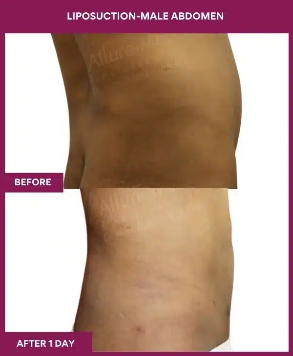 2 LIPOSUCTION-MALE ABDOMEN_6_ (2)