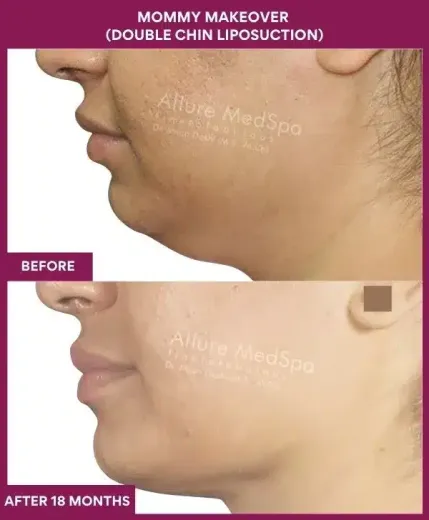 2 Mommy Makeover (DOUBLE CHIN LIPOSUCTION) (3)_82