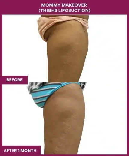 2 Mommy Makeover (Thighs Liposuction)_99 (4)