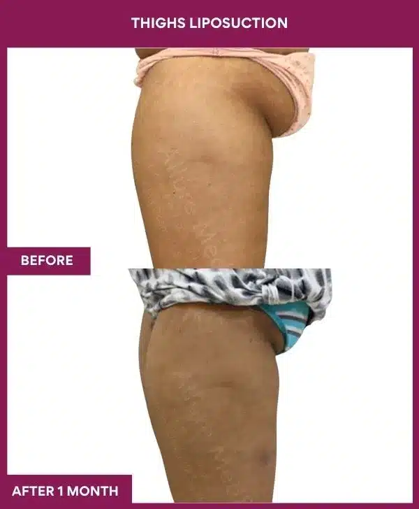 2 Thighs Liposuction (7)_75