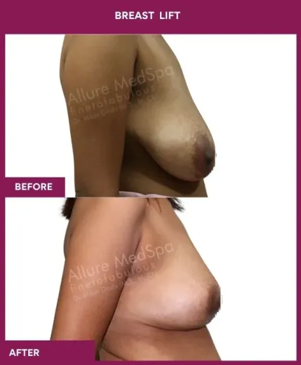 2 breast lift_6_ (1)
