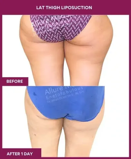 20 LAT THIGH LIPOSUCTION--