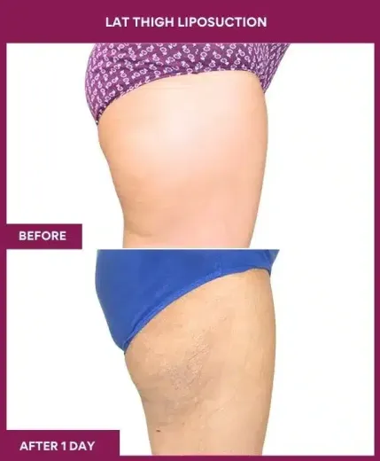20 LAT THIGH LIPOSUCTION-