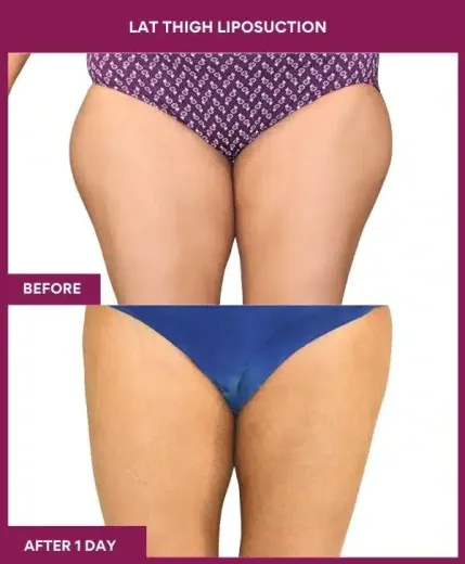 20 LAT THIGH LIPOSUCTION