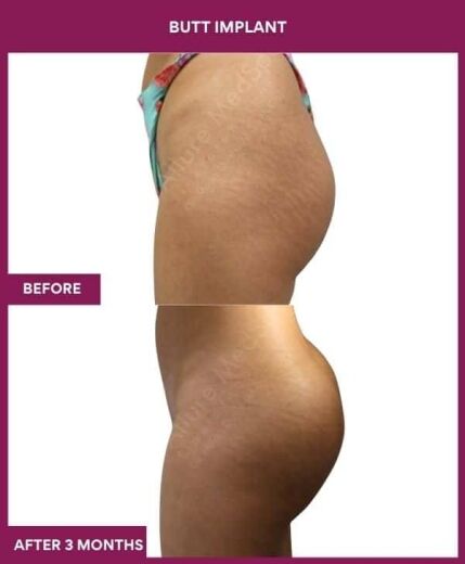 3 BUTT IMPLANT in Mumbai, India