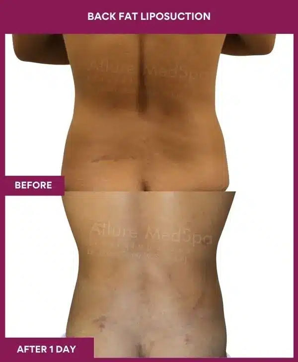 3 Back Fat Liposuction_37