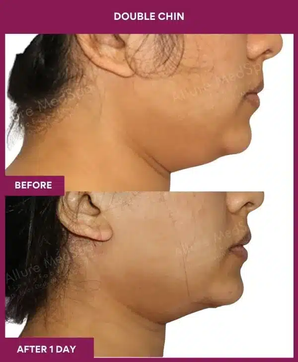 3 Double Chin (2)_54