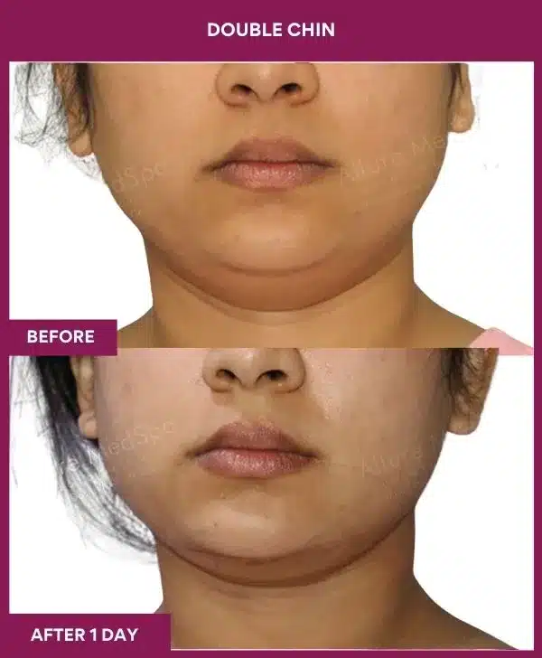 3 Double Chin (4)_54