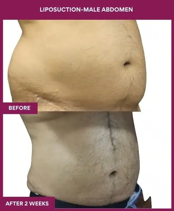 3 LIPOSUCTION-MALE ABDOMEN (5)_8_