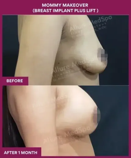 3 Mommy Makeover (BREAST IMPLANT PLUS LIFT ) (3)_
