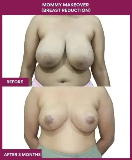 3 Mommy Makeover (Breast Reduction)_55 (1)