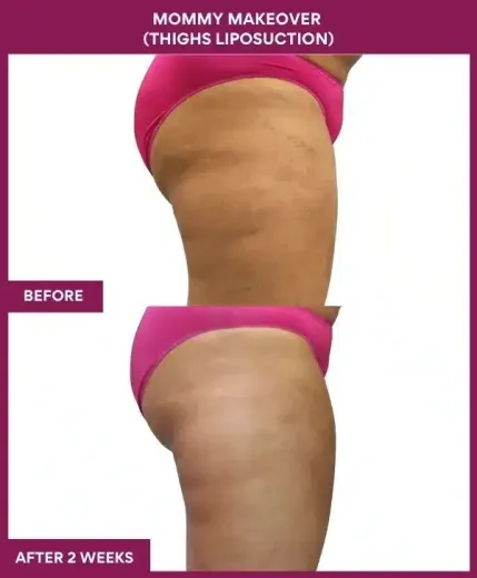 3 Mommy Makeover (Thighs Liposuction) (3)_101